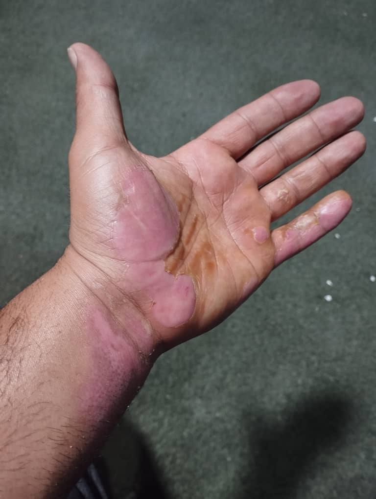 Burn — After treatment