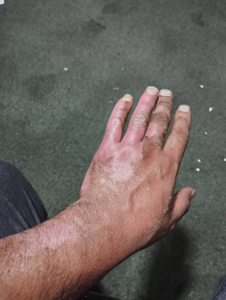Burn — After treatment