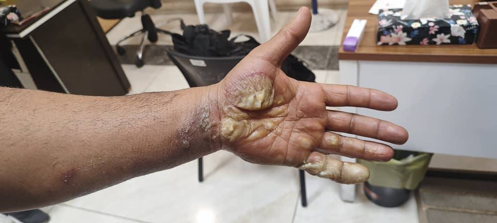 Burn — Before treatment