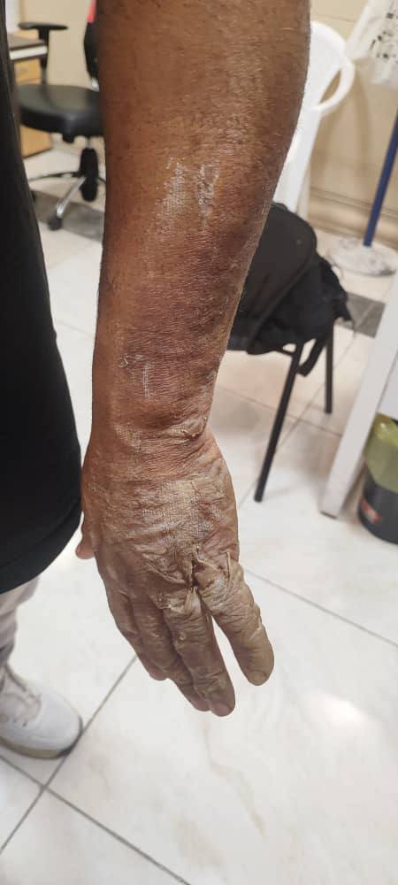Burn — Before treatment